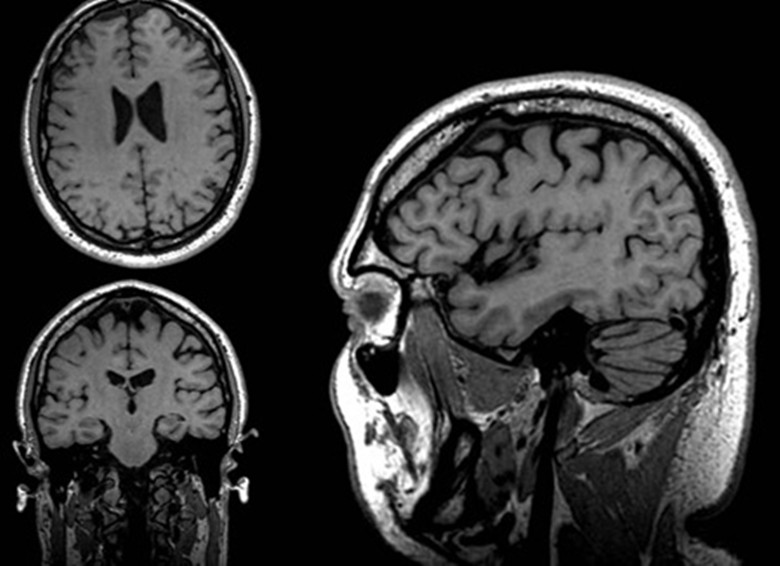 MRI对人脑的成像